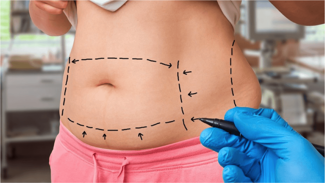 5 Mitos Acerca de la Liposucción
